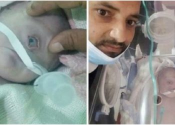 حالة نادرة.. ولادة طفل يمني بعين واحدة!