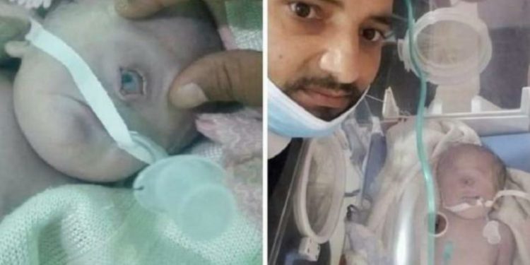حالة نادرة.. ولادة طفل يمني بعين واحدة!
