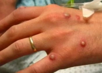 وزارة الصحة تعلن عن النتائج المخبرية للحالات الثلاث المشتبه في إصابتها بفيروس جدري القردة