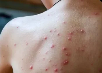 الطيب حمضي يكشف تفاصيل حول فيروس جدري القردة