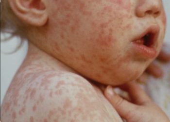 وزارة التربية الوطنية تطلق حملة تلقيح ضد بوحمرون في المدارس