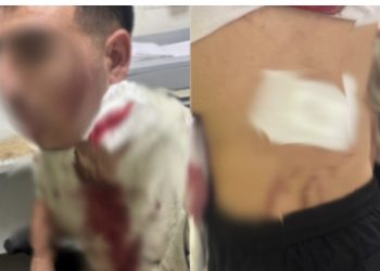 محاولة سرقة تتحول إلى اعتدا-ء  دمو-ي بالبرنوصي.. وضحي-ة يكشف معاناته النفسية