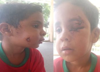 هجوم كلب ضال يصيب طفلاً بجرو-ح  خطير-ة  في تارودانت.. دعوات لتدخل عاجل والتكفل بحالته