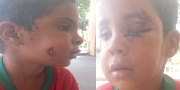 هجوم كلب ضال يصيب طفلاً بجرو-ح  خطير-ة  في تارودانت.. دعوات لتدخل عاجل والتكفل بحالته