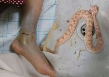 فاطمة أوبلال.. مأسا-ة لدغة أفعى تكشف واقع الخدمات الصحية في الجنوب الشرقي