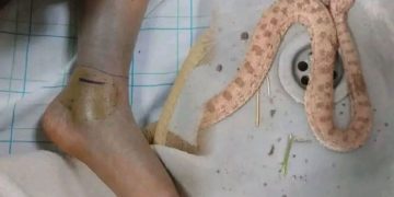 فاطمة أوبلال.. مأسا-ة  لدغة أفعى تكشف واقع الخدمات الصحية في الجنوب الشرقي